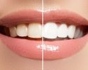 Tips Memilih Produk Pemutih Gigi