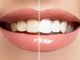 Tips Memilih Produk Pemutih Gigi